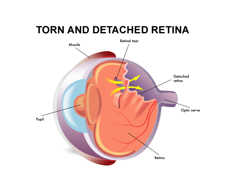 Detached Retina and Torn Retina