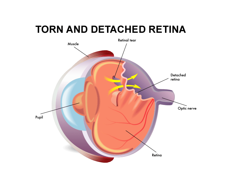 repairing a detached retina