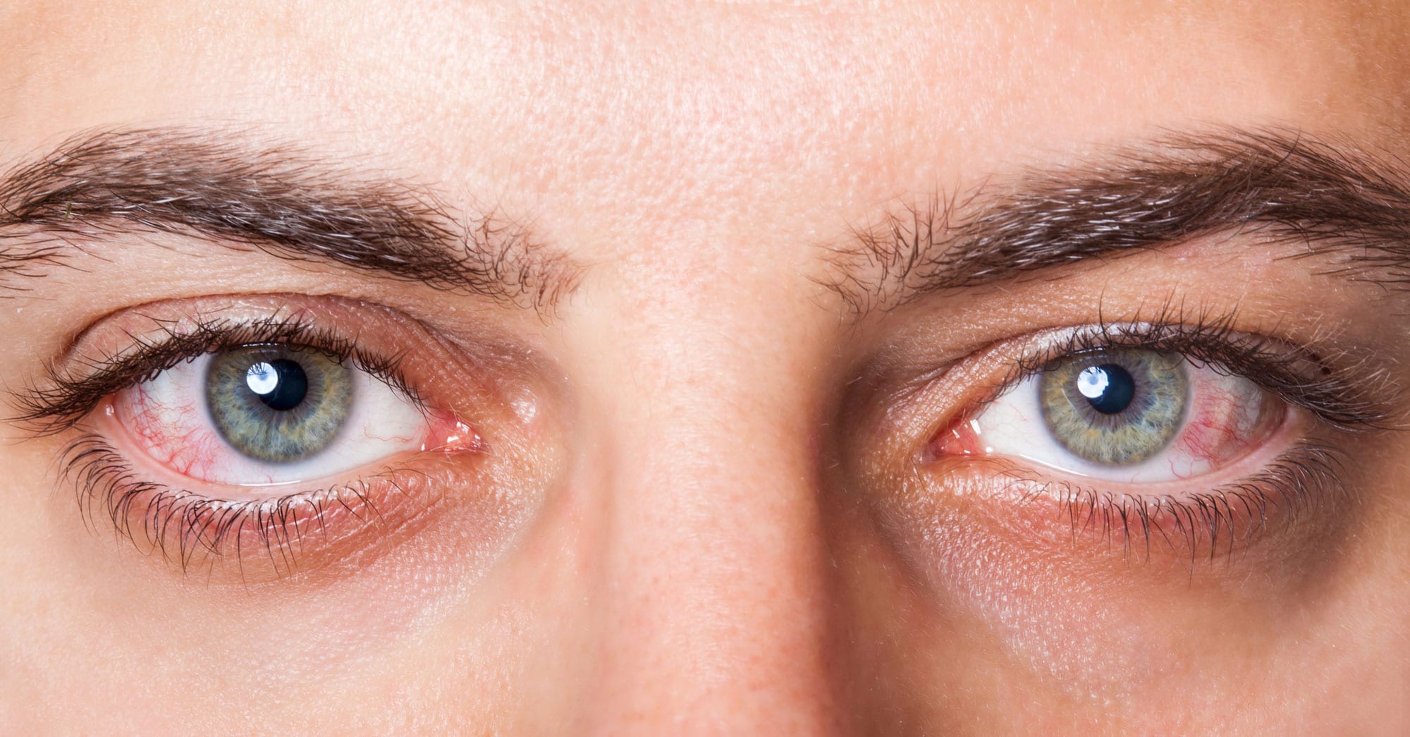 Treatments to Relieve Dry Eyes | Florida Eye