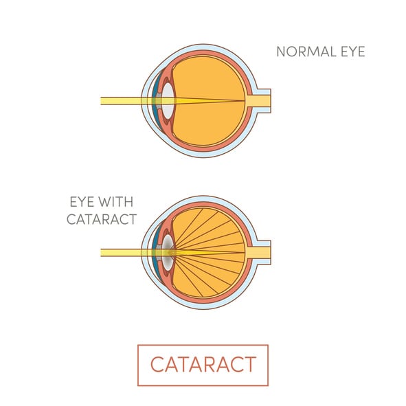 Cataracts Comparison with Healthy Eye