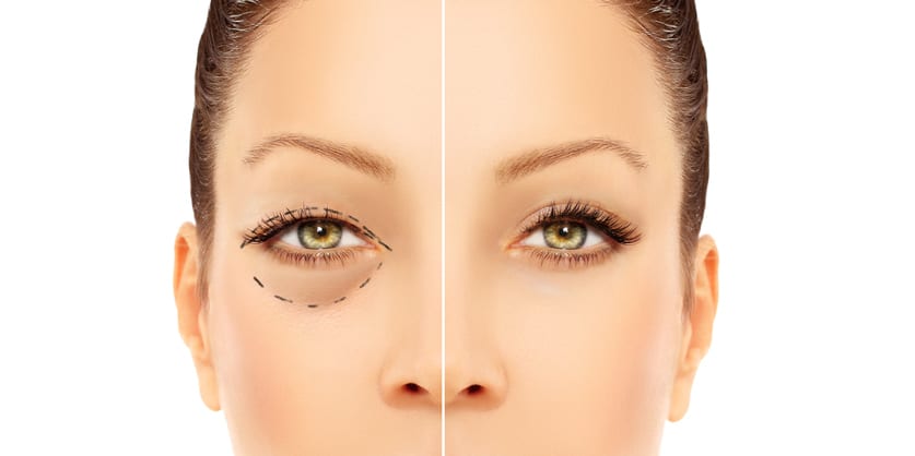 Blepharoplasty Patient Upper and Lower Procedure