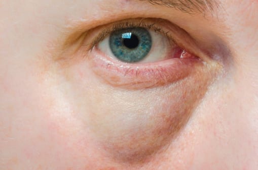 Puffy Eyes and Dark Circles Treatment Blepharoplasty Procedure