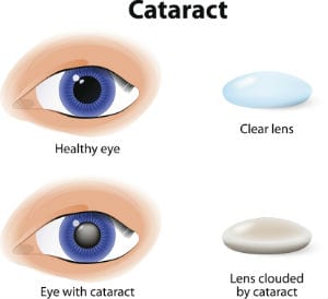 Cataracts