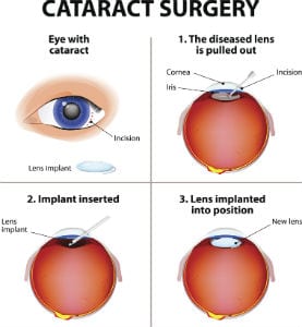 Cataracts