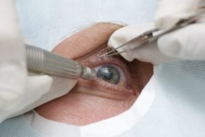 Understanding Cataract Surgery