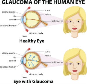 Glaucoma