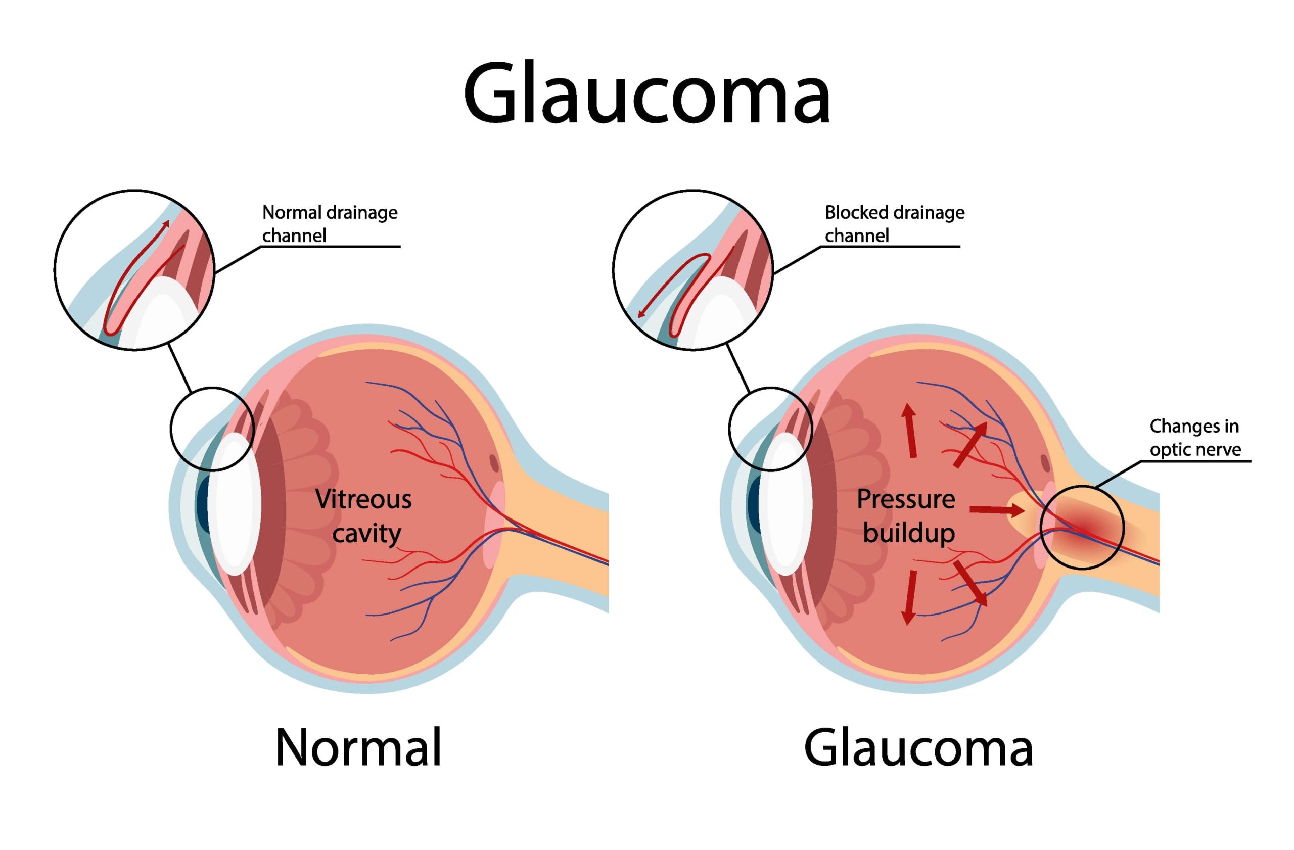 Glaucoma and Normal Eye Graphic