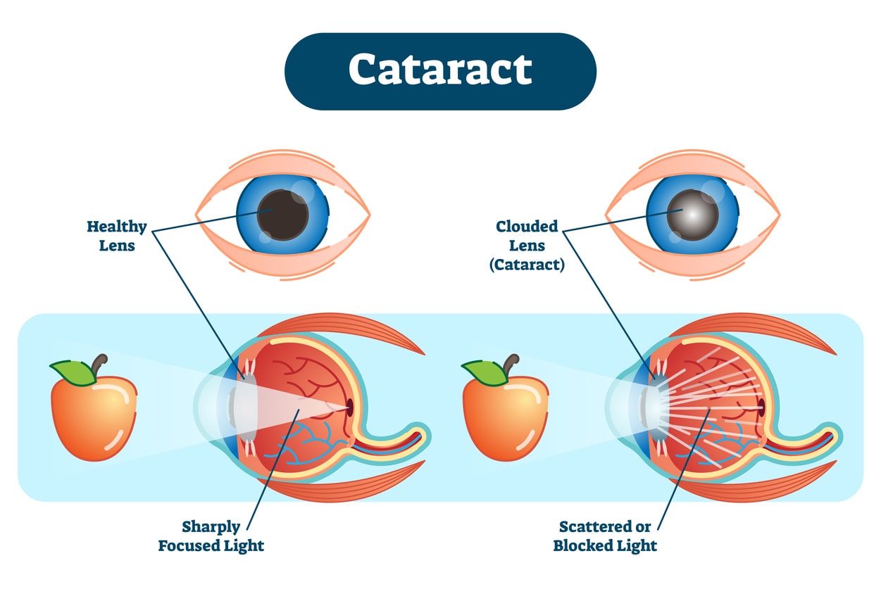 Diagram of a healthy eye and an eye with a cataract