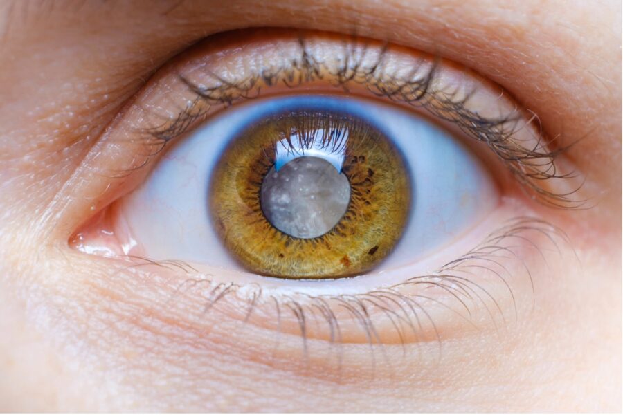 Understanding Cataracts