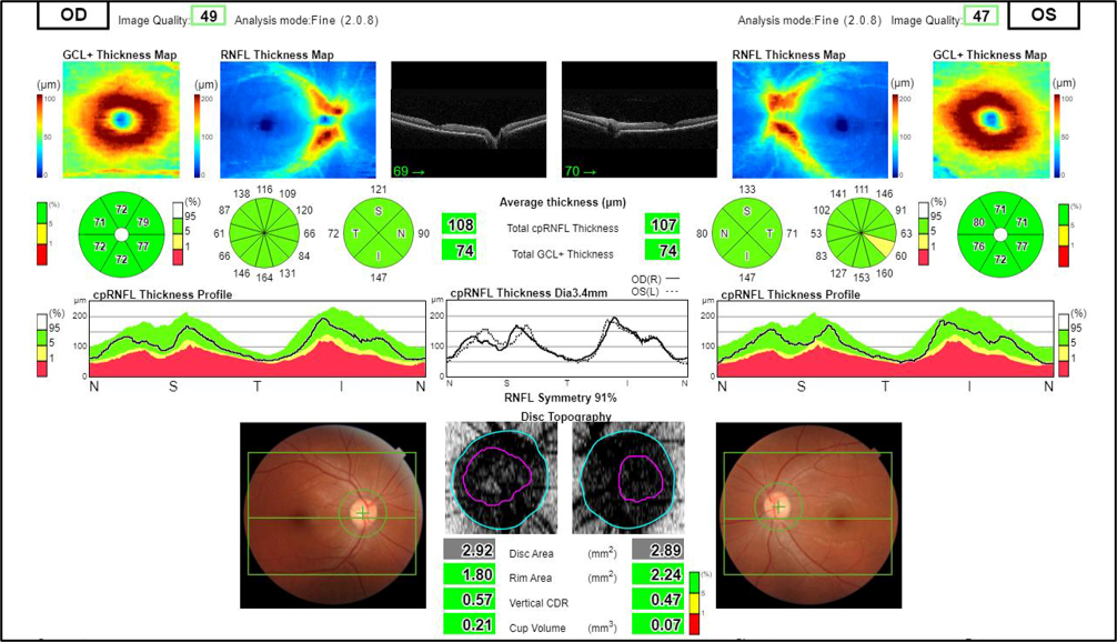 OCT scan readout showing GCL and RNFL thickness maps, cpRNFL thickness profile, and disc topography for both eyes
