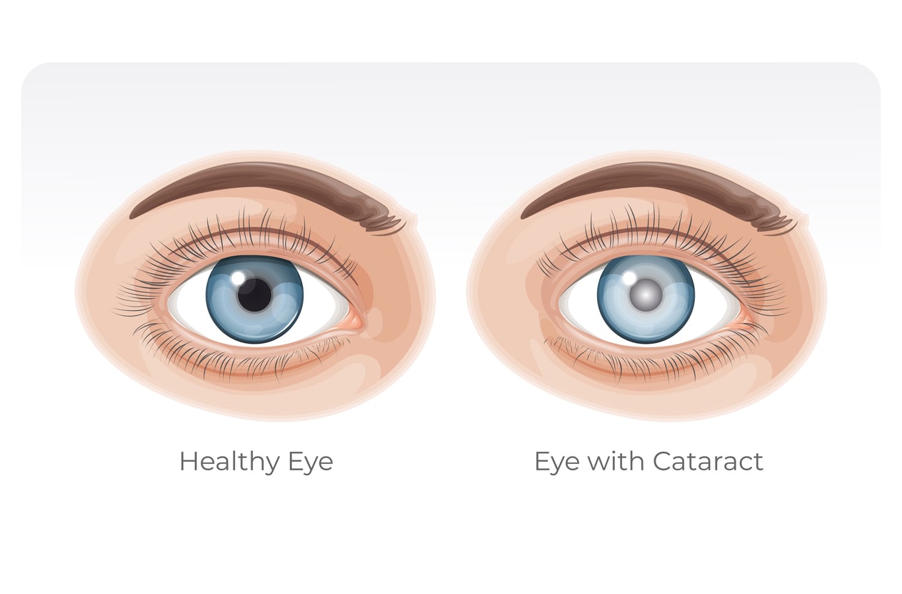 Graphic of a healthy eye versus an eye with cataract