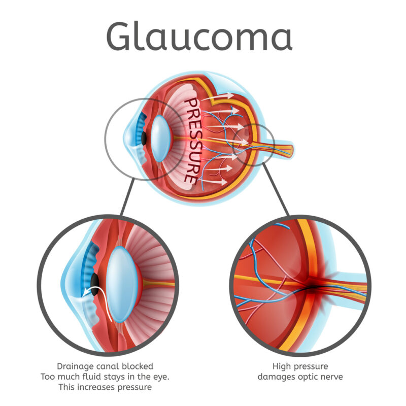 Can Glaucoma be Reversed? - Florida Eye Specialists