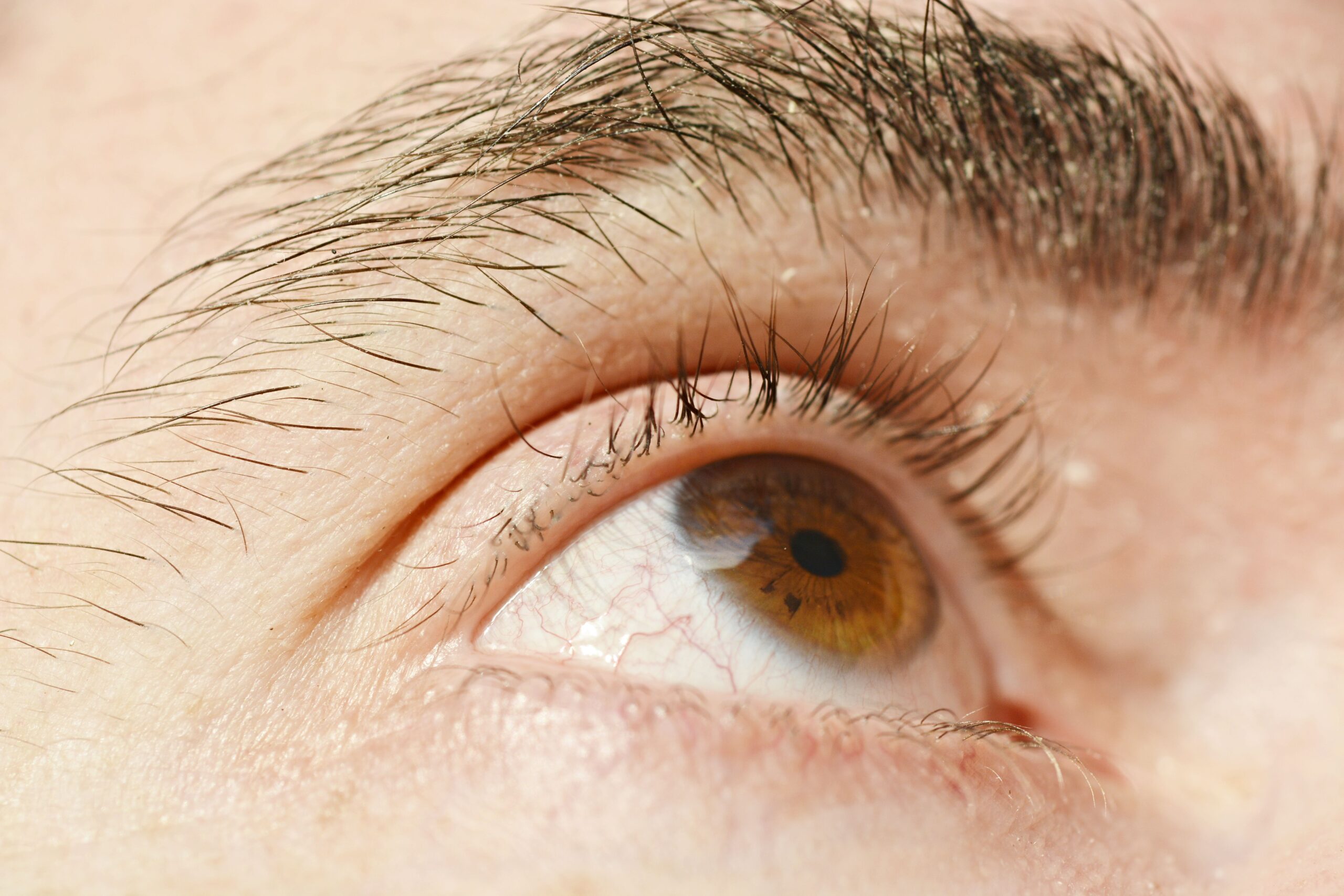 Dry Eye July Blog